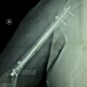 Cirugía de fracturas y lesiones traumatológicas 