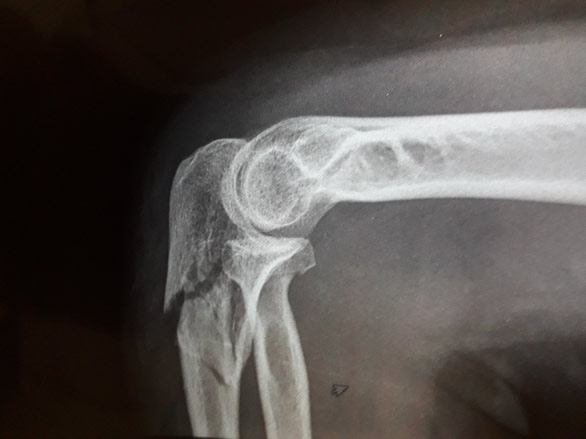Cirugía de fracturas y lesiones traumatológicas 